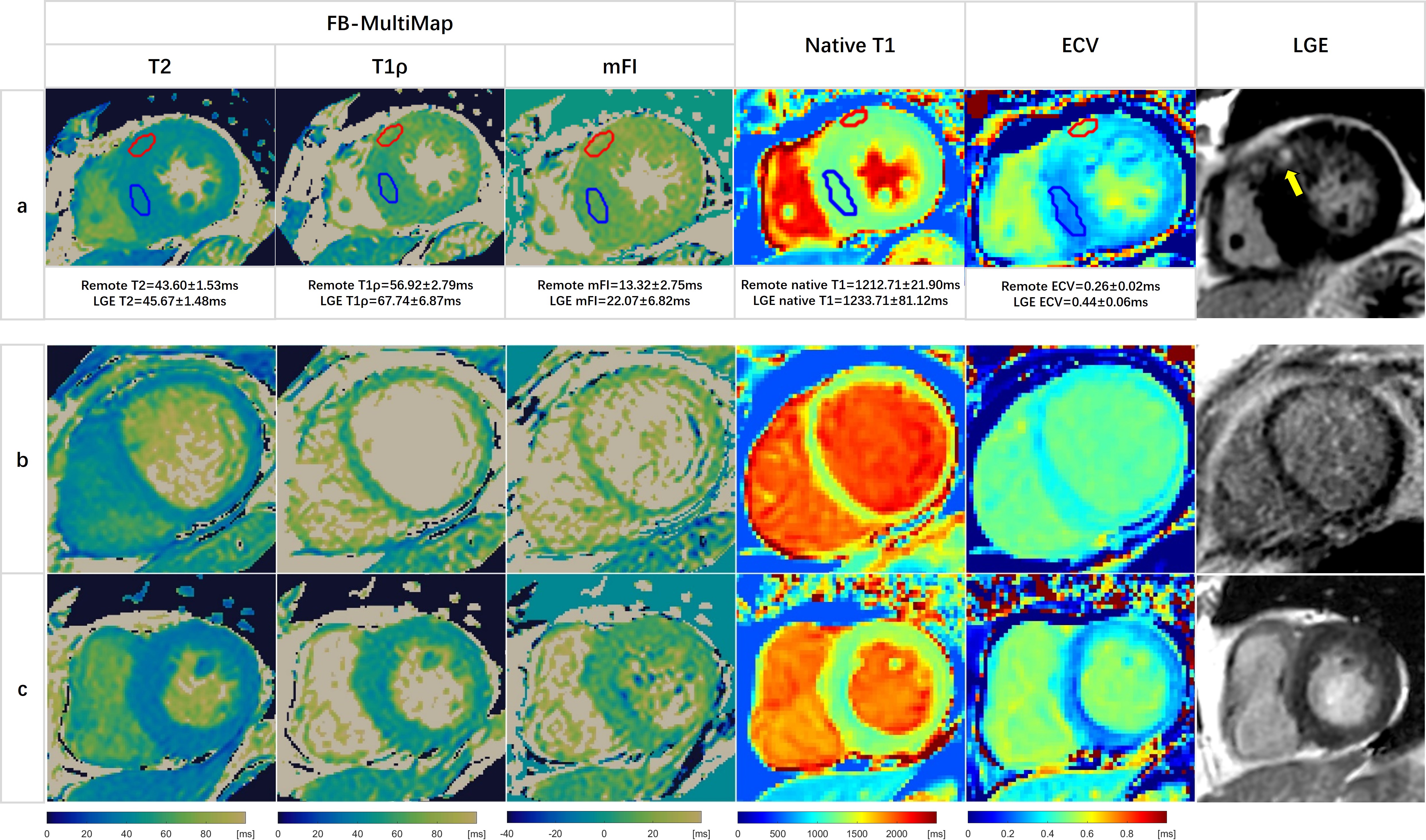3D high-resolution cardiac MRI